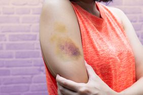 Bruise on woman arm. Injection bruises. Doctor and patient.