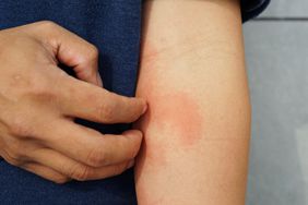 Allergic rash dermatitis eczema skin on forearm of patient