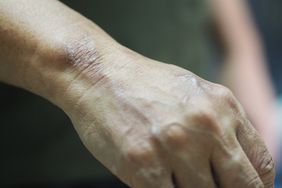 leprosy skin symptoms on the back of a woman's hand