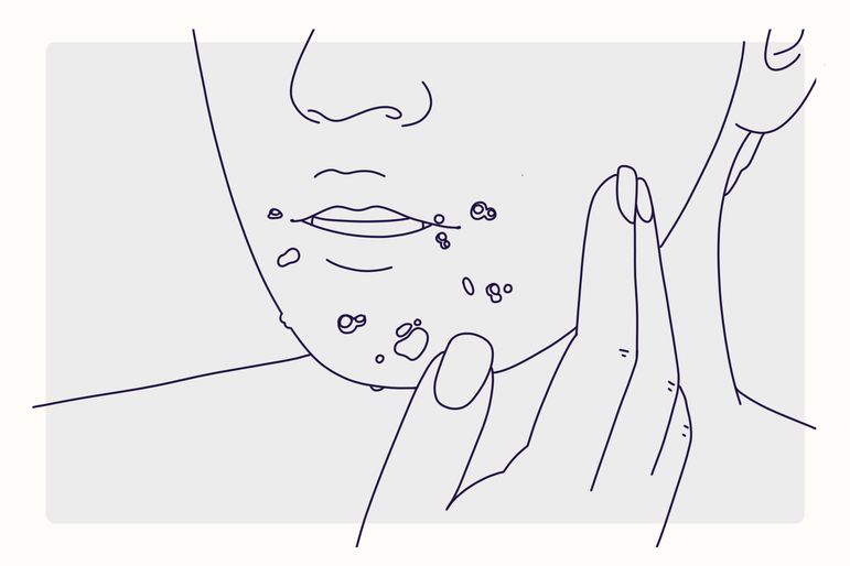 Illustration for acne