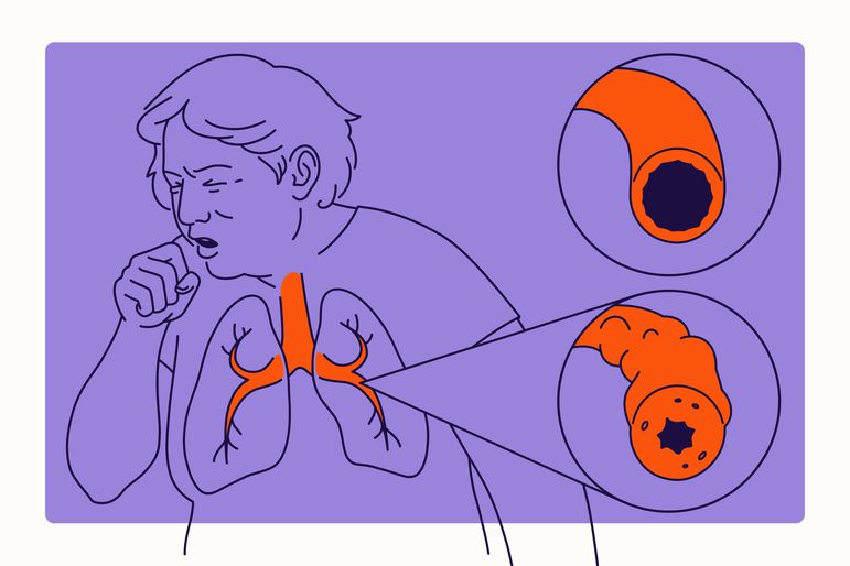 Overview Illustration - COPD
