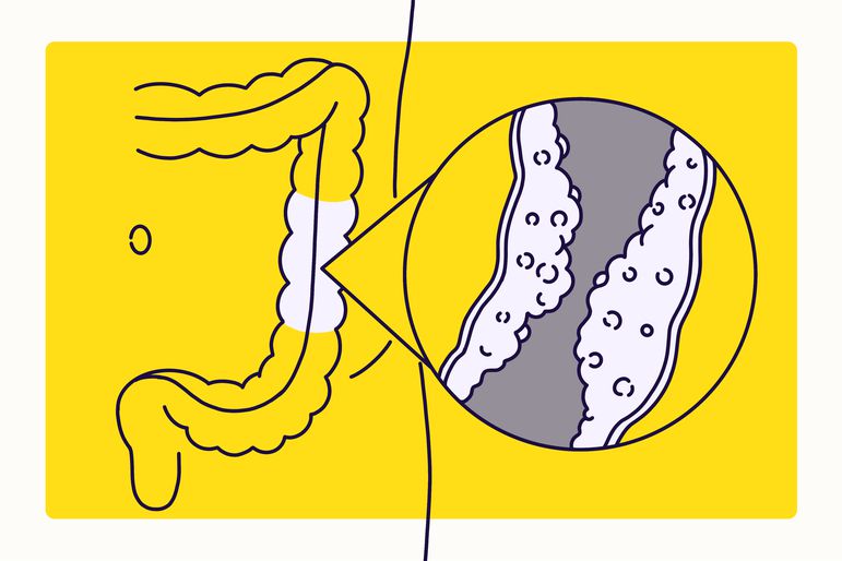 Overview Illustration - Crohn's Disease