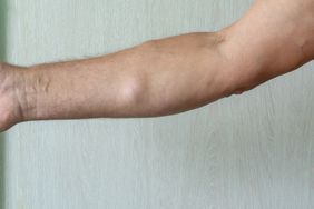 Lipoma - Person with lipomas on arm