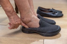 Person with swollen feet putting on shoes
