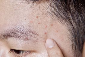 Acne Mechanica or sports-induced acne or whiteheads or mild acne at forehead