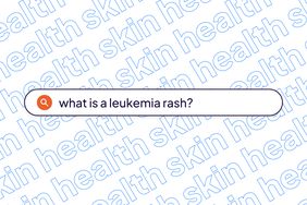 Skin Health Template- Leukemia Rash