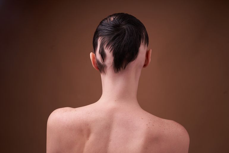 The back of the head of a young woman with brunette hair and alopecia (hair loss).