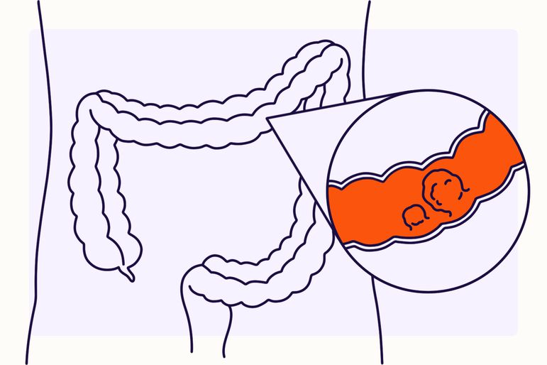 Illustration of colorectal cancer
