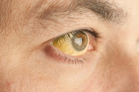 A close-up of a person's eye, with the white part yellowed