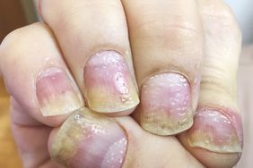 nail-pitting-psoriasis