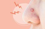 nose-pimple , close up of facial acne for health concept