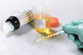 A urine pH test