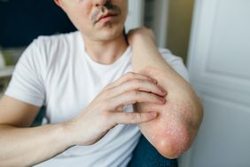 man with psoriasis touching arm