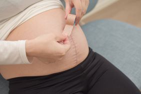 A young pregnant woman is caring for a scar with silicone scar tape.